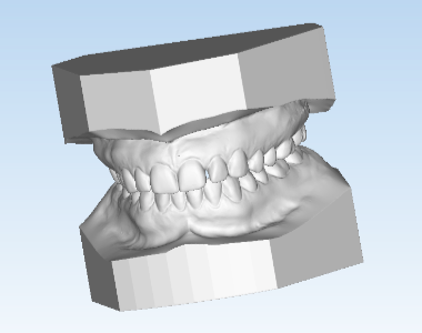 Digital Study Models Study Models - Rodwell Orthodontic Laboratory - eDontics